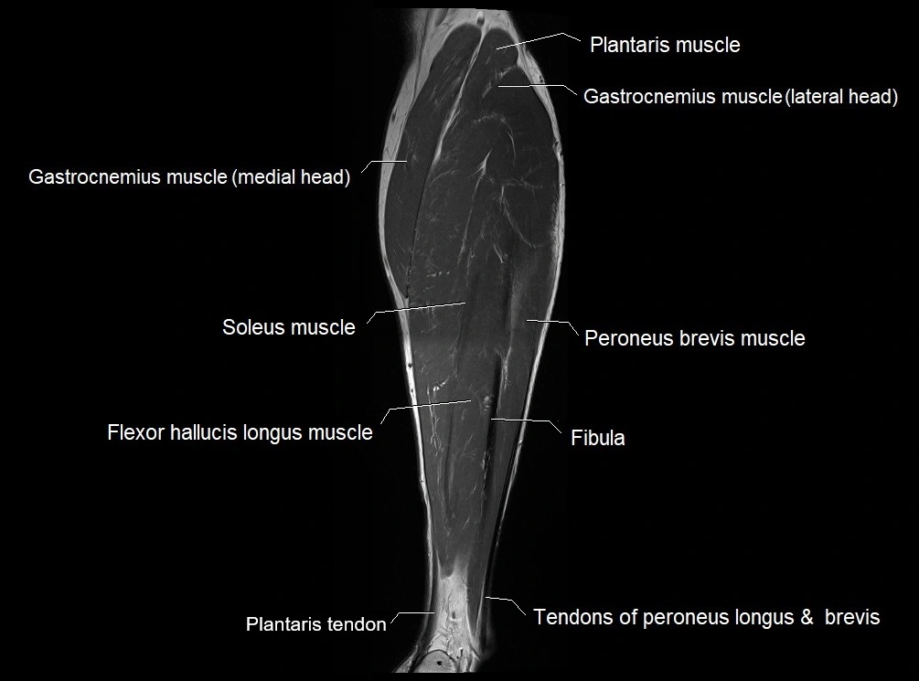 MRI 3T leg (tibia & fibula) labelled coronal cross sectional anatomy image 23.webp